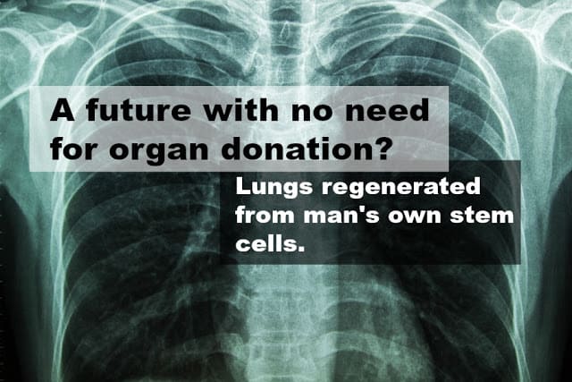 Goodbye Organ Donation – Scientists Generated Healthy Lung Tissue From Man’s Own Stem Cells 1 Goodbye Organ Donation – Scientists Generated Healthy Lung Tissue From Man’s Own Stem Cells